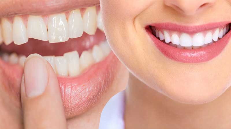 Cosmetic Detistry
