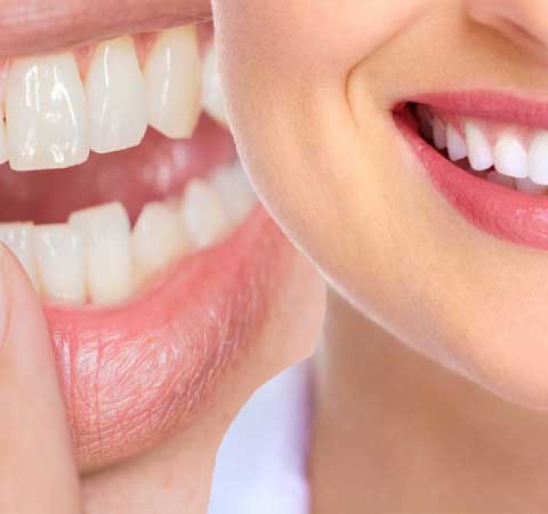 Cosmetic Detistry